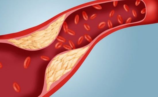 Dầu cám gạo giúp giảm mỡ máu