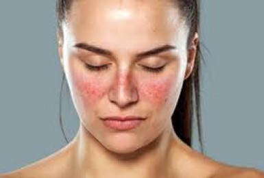 Artemisinin – phương pháp mới, đầy hứa hẹn trong điều trị bệnh Lupus ban đỏ hệ thống (Artemisin lupus) Artemisinin – phương pháp mới, đầy hứa hẹn trong điều trị bệnh Lupus ban đỏ hệ thống (Artemisin lupus)